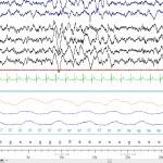 Sleep Brain Waves